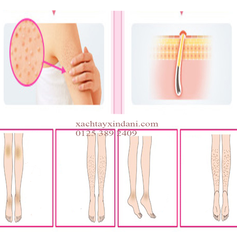 Kem trị viêm lỗ chân lông Kobayashi nhật – trị viêm lông tốt nhất